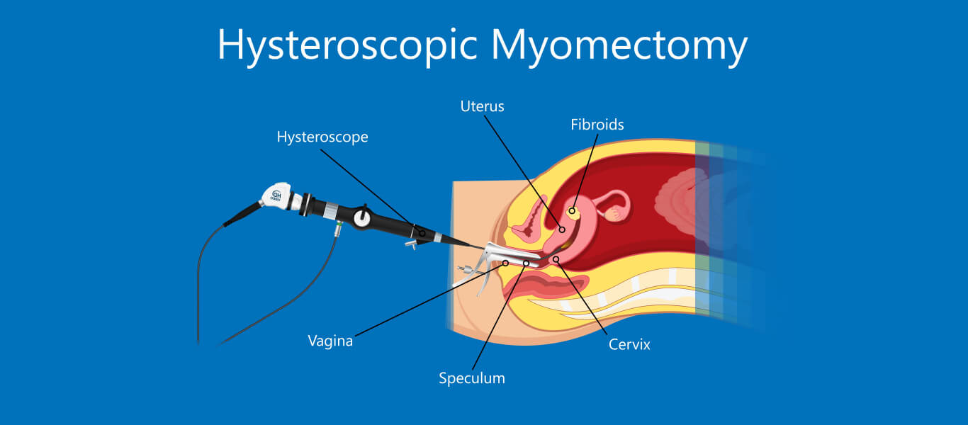 Hysteroscopy Polypectomy for Infertility
